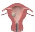 distend-the-uterus