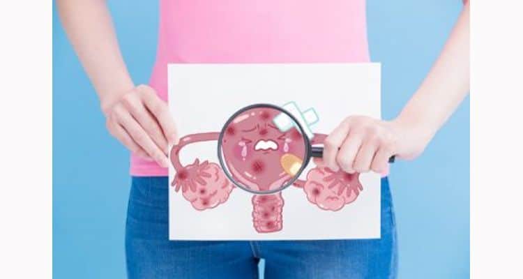 cervical cancer