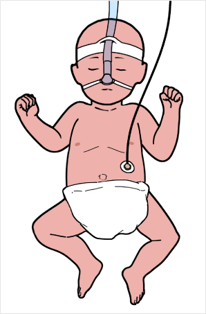 Abdominal respiratory sensors